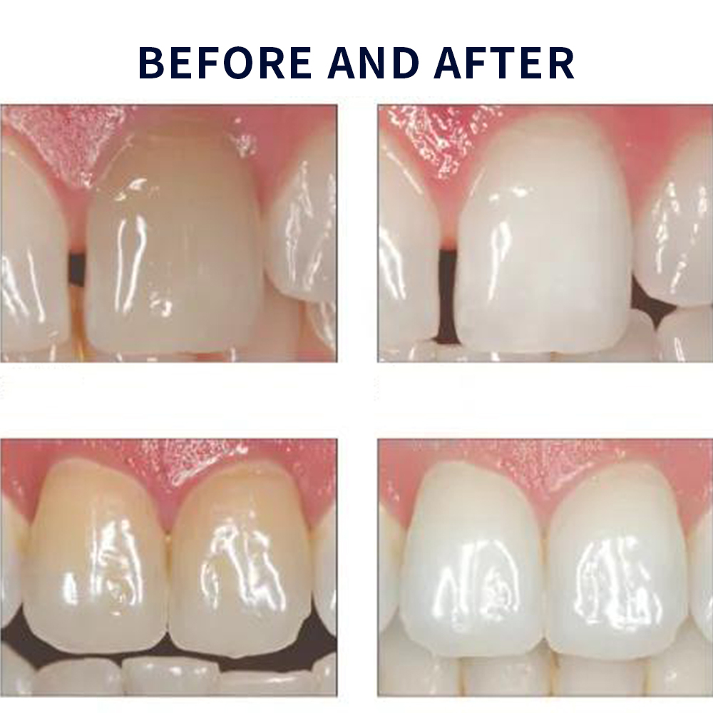 유백광 미백 20% PF 20 16 젤 키트, 초강력  - Teeth Whitening Doctor 리뷰 및 가격
