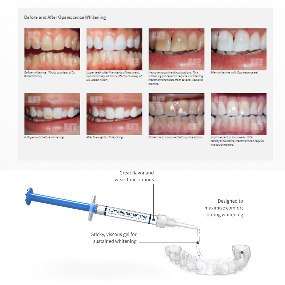 유백광 미백 20% PF 20 16 젤 키트, 초강력  - Teeth Whitening Doctor 리뷰 및 가격