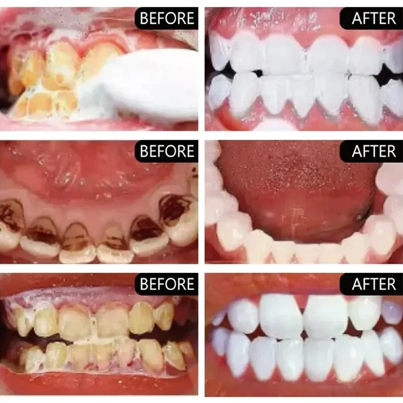 빠른 연기 얼룩 제거 치약 플라크 얼룩 제거 구강 위생 - Teeth Whitening Fast 리뷰 및 가격