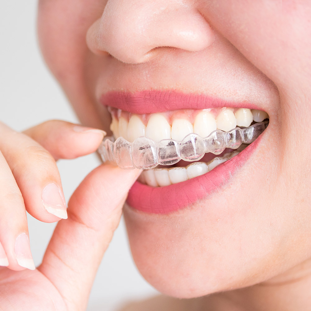 2/4개입 전문 치아 교정기 세트 투명 마우스가드 위생 - Teeth Whitening With Trays 리뷰 및 가격