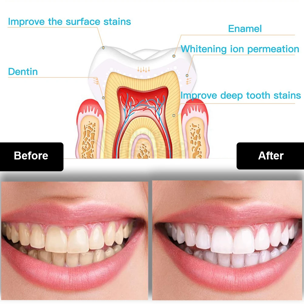 치과 치아 미백 키트 미니 16 LED 콜드 라이트 3 - Teeth Whitening Accelerator 리뷰 및 가격